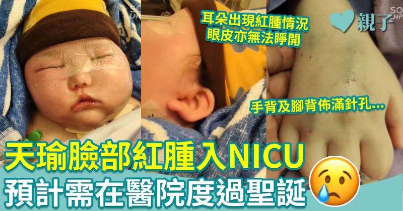 天瑜臉部紅腫入NICU 預計需在醫院度過聖誕