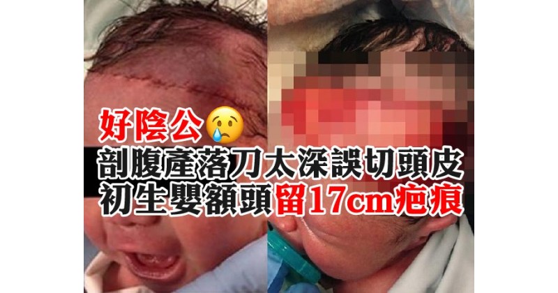 【好陰公】剖腹產落刀太深誤切頭皮 初生嬰額頭留17cm疤痕