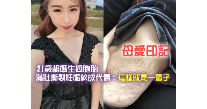 【母愛印記】21歲靚媽生四胞胎 滿肚撕裂妊娠紋成代價：這樣就是一輩子