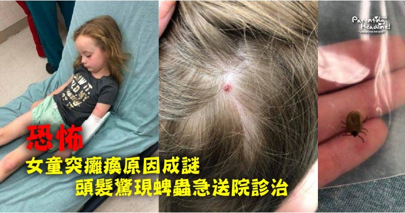 【恐怖】女童突癱瘓原因成謎 頭髮驚現蜱蟲急送院診治
