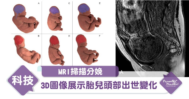 【MRI掃描分娩】3D圖像展示胎兒頭部出世變化