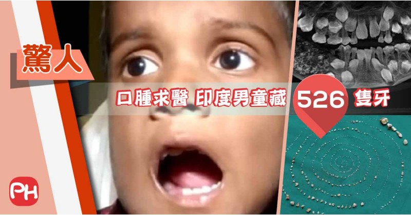 【驚人】口腫求醫 印度男童藏526隻牙
