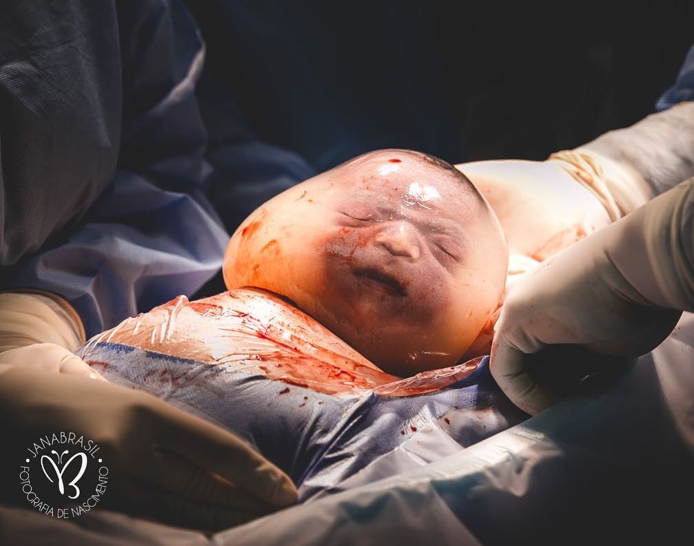 【十萬分之一】鬼馬男嬰連羊膜囊出世 被拍下珍貴照片