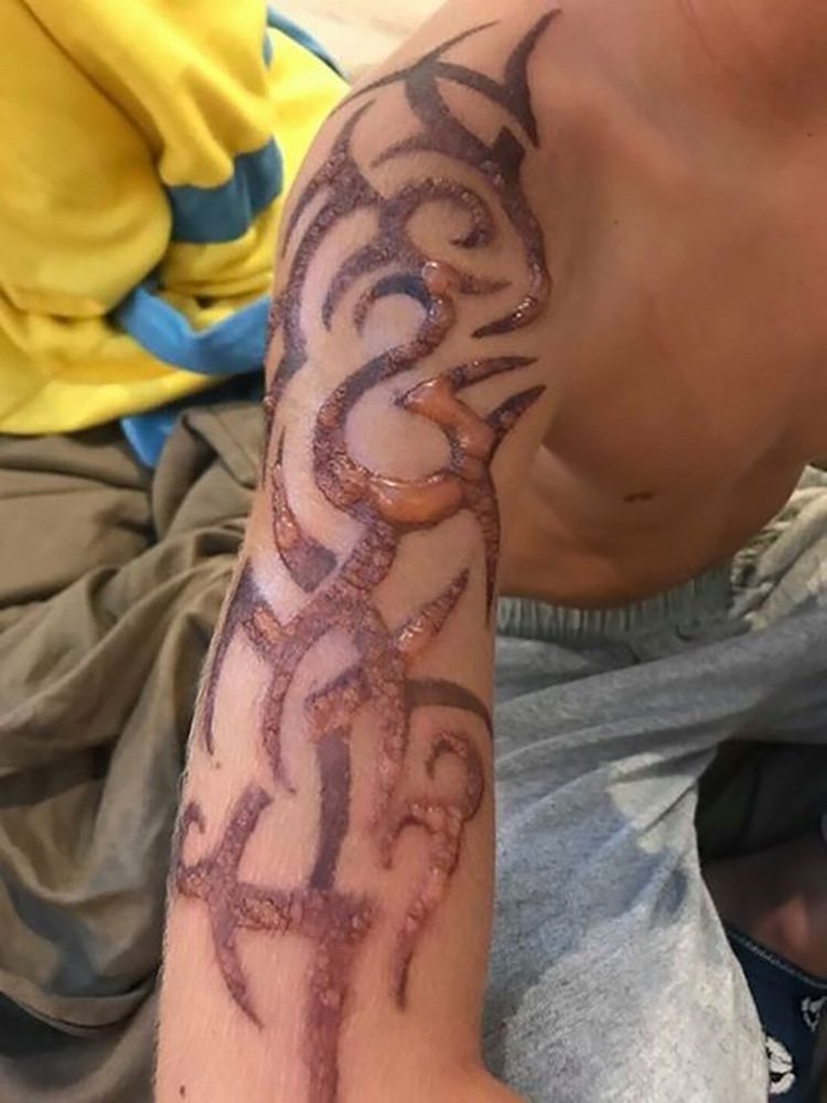【慎入】Henna紋身出事 兩男童手臂灼傷