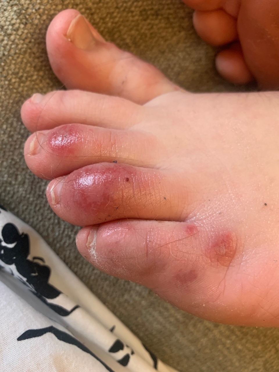 【突變】無症狀兒童唯一病徵？美醫：COVID腳趾會發紫發癢